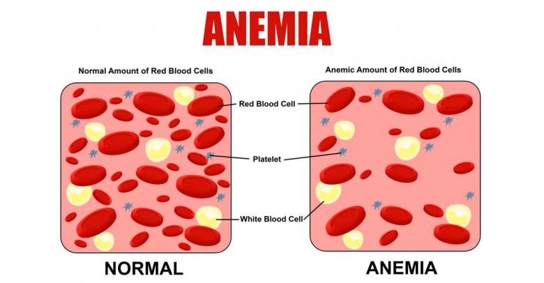 Anemia, síntomas y causas