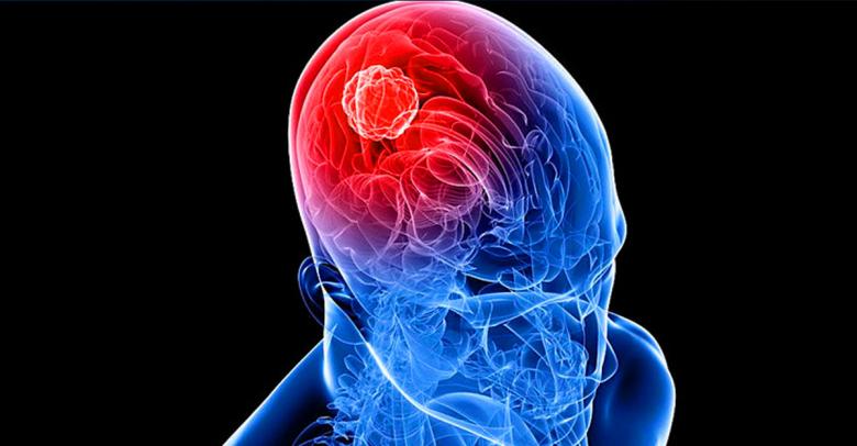 ¿Qué son los tumores cerebrales?