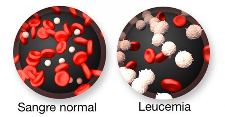 ¿Qué es la leucemia?